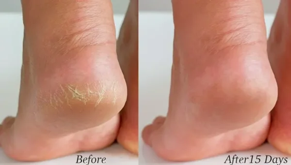 Handmade Tea Tree Salve - Foot Care, Hydrate, Antibacterial - 2 oz