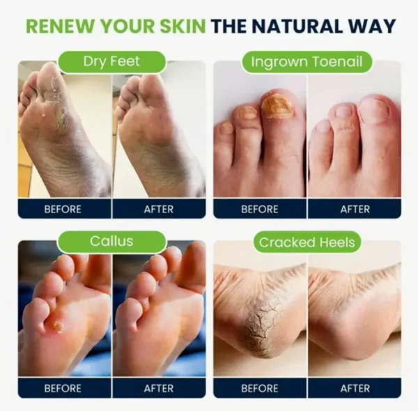Tea Tree Foot Soak with Toenail Care