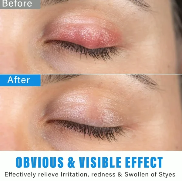 Chalazion Vision Treatment Serum for Fast Efficacy