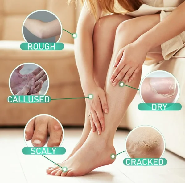 Urea 40% Foot Lotion with 2% Salicylic Acid - Best Exfoliant